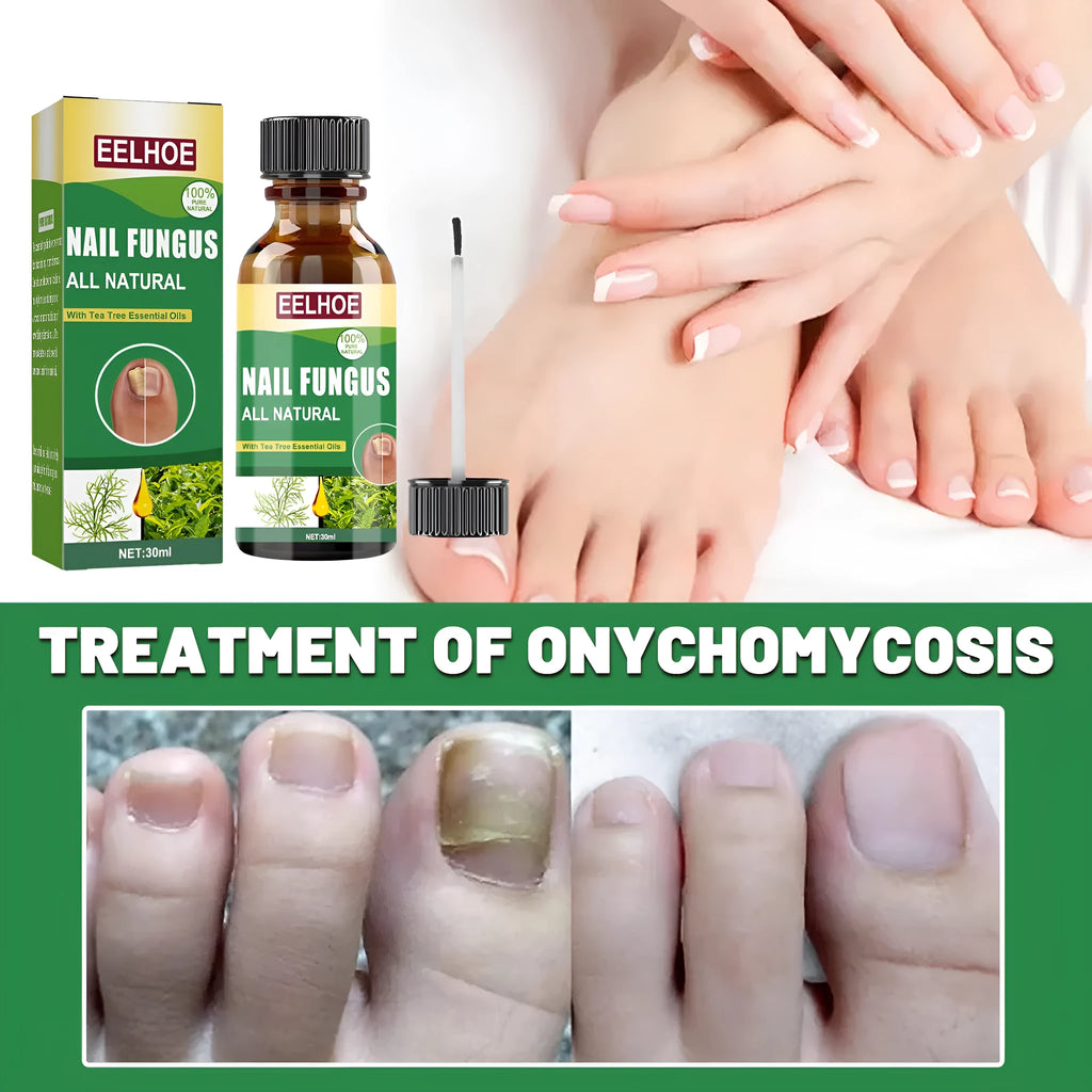 30ml tea tree oil nail care solution bottle for thick soft hand and foot nails