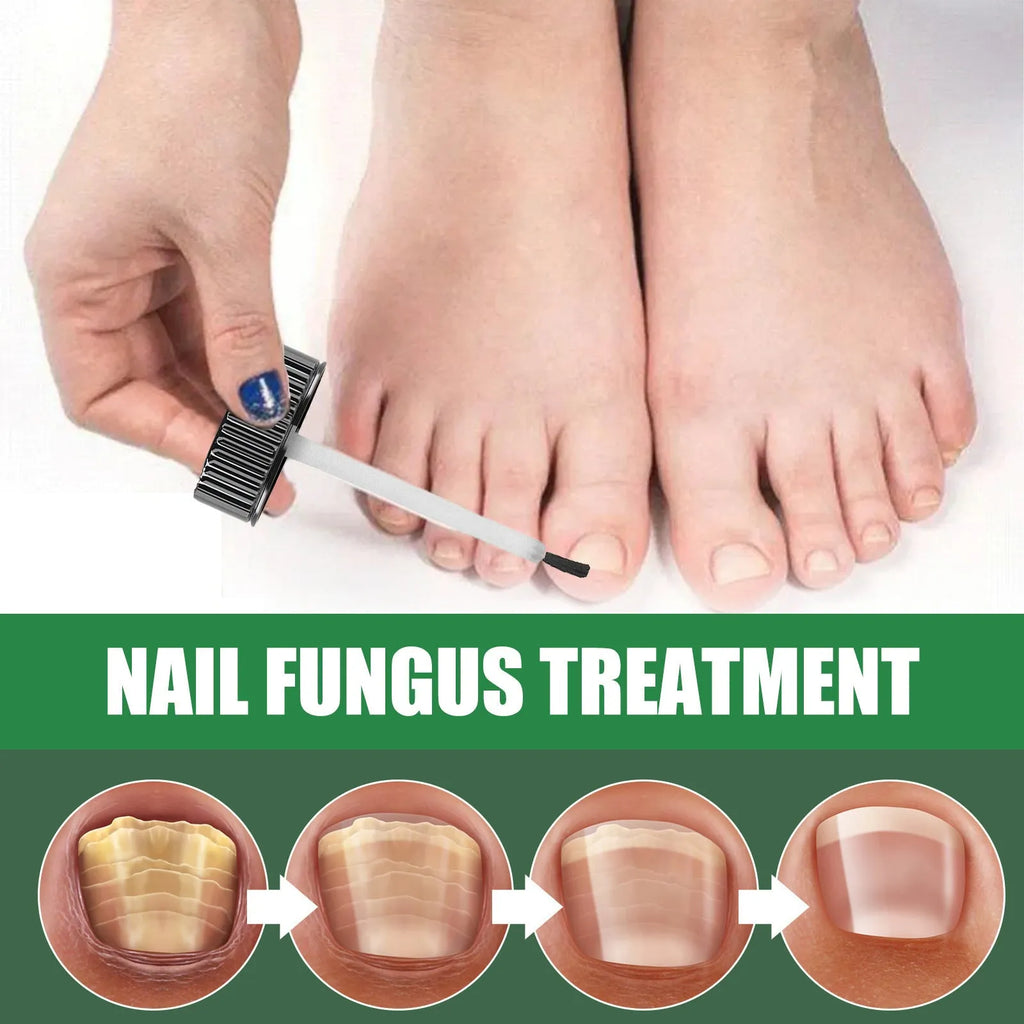 30ml tea tree oil nail care solution bottle for thick soft hand and foot nails