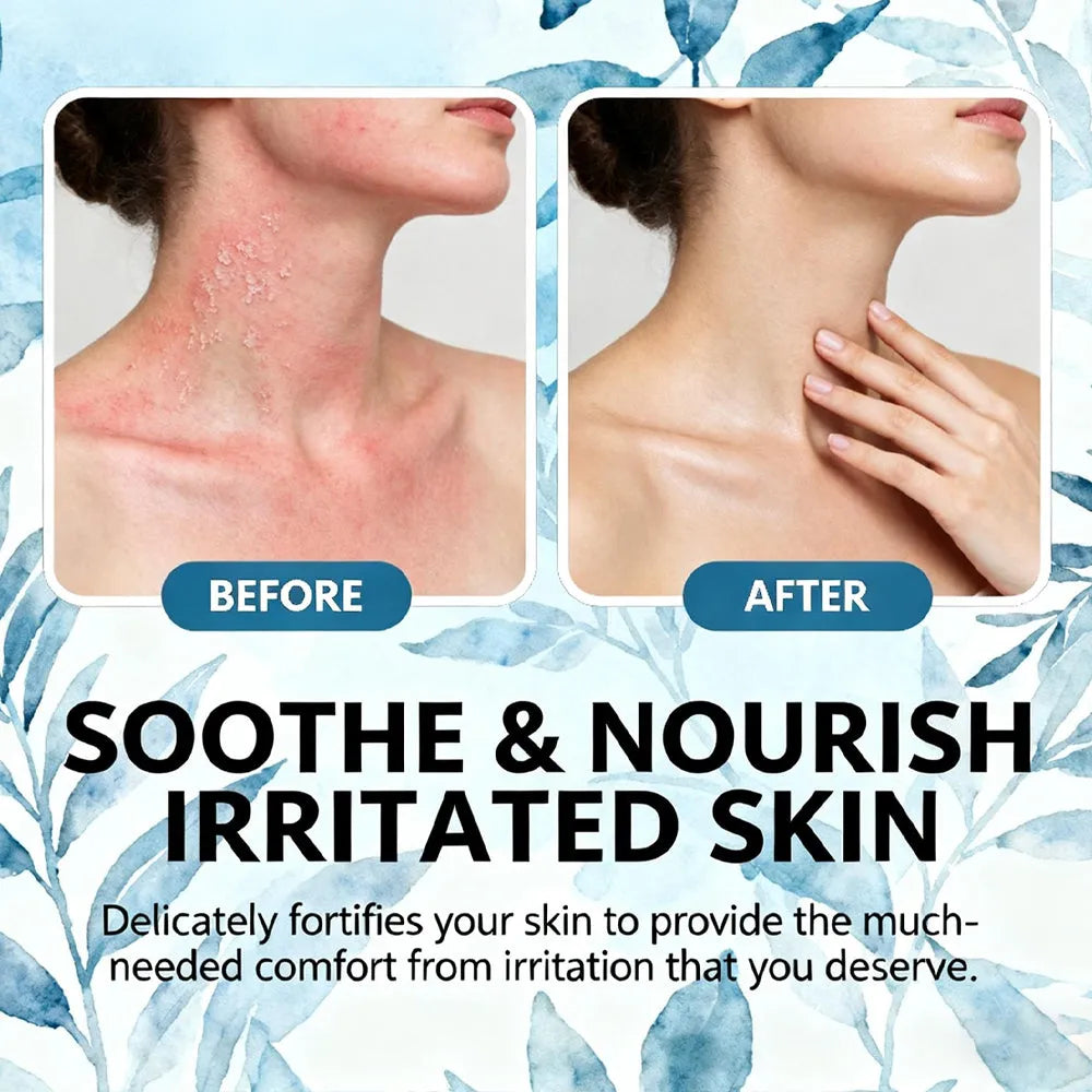 Seborrheic dermatitis cream 100ml tube soothing relief for flaky dry scalp and itchy skin